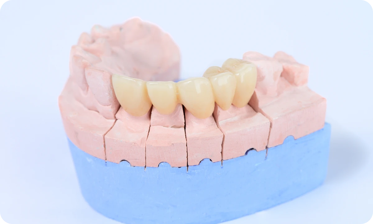 セラミック治療について