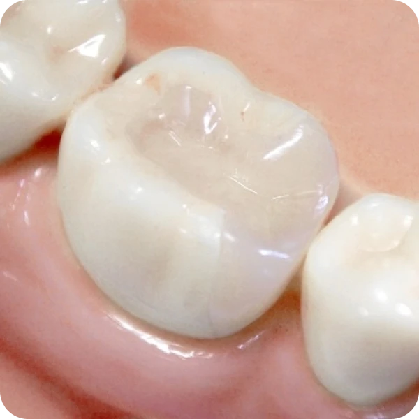 当院のセラミック治療