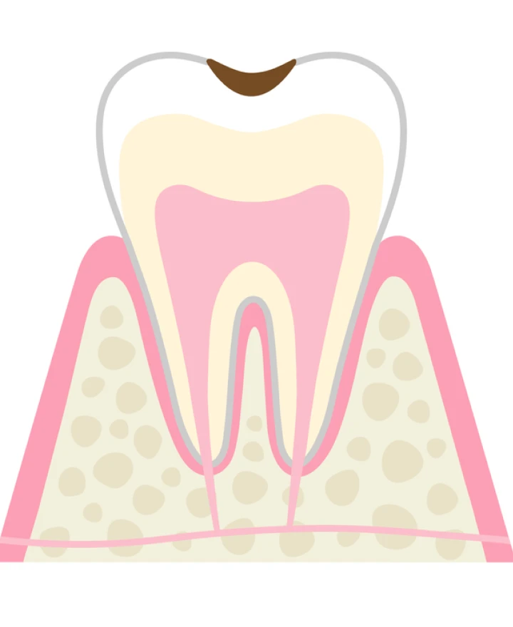 C1 エナメル質の虫歯