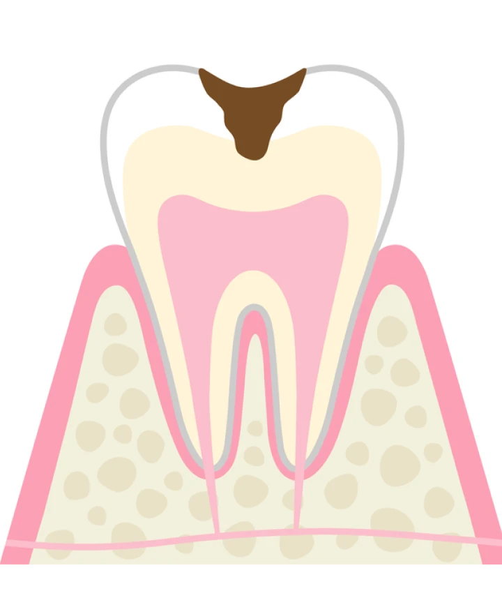 C2 象牙質の虫歯