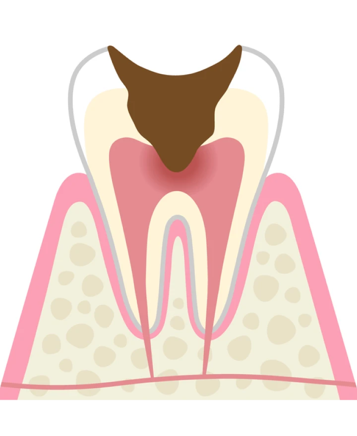 C3 神経まで進行した虫歯