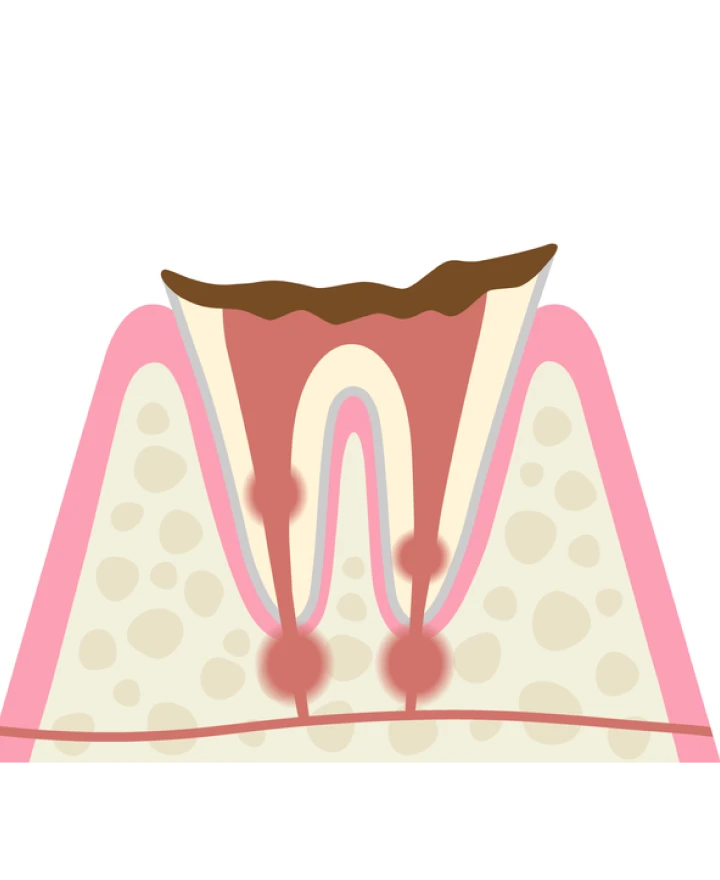 C4 歯根まで進行した虫歯
