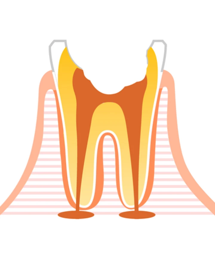 表面にある虫歯を取り除きます。