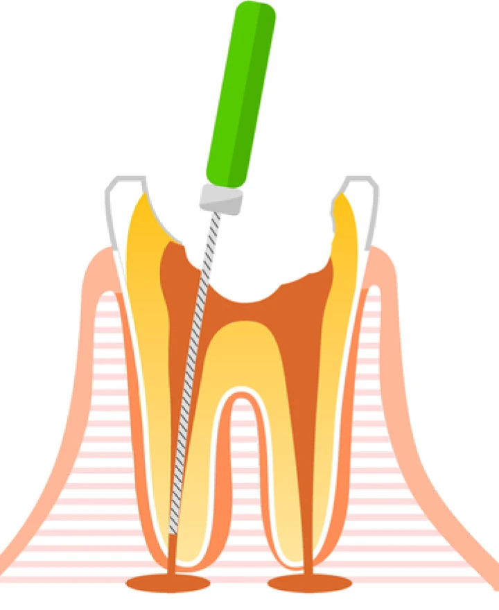感染を起こした神経を、専用の器具を用いて掻き出し、汚れの洗浄と消毒を行います。