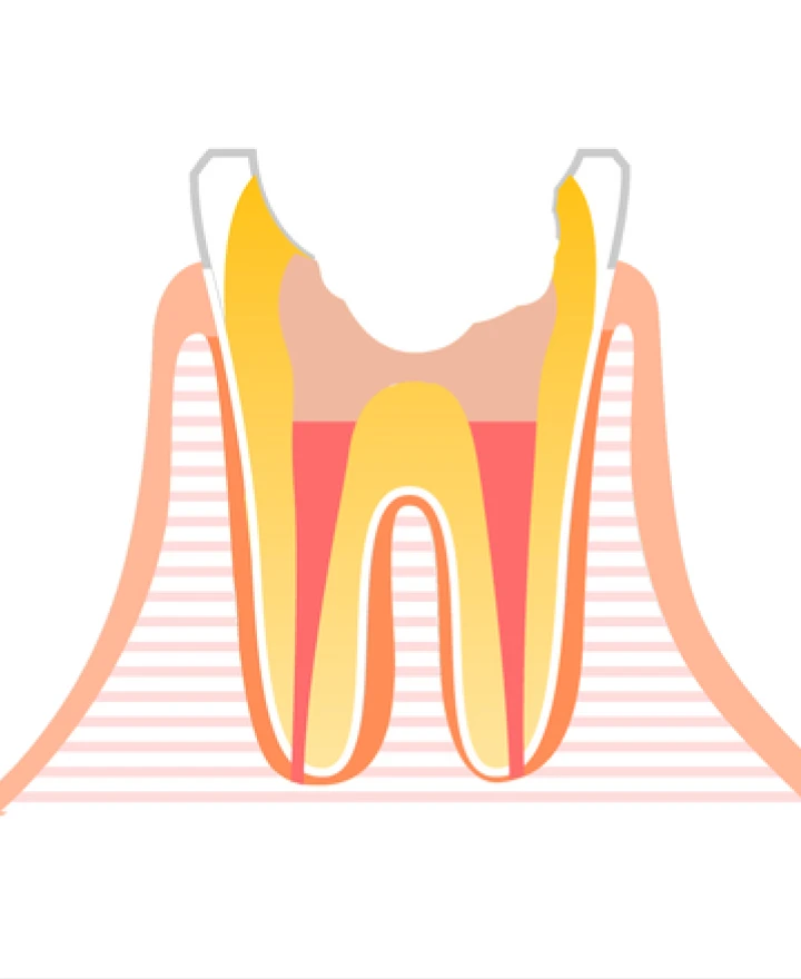 綺麗にした根管内への細菌侵入を防ぐために、専用の薬剤で根管を隙間なく詰めます。