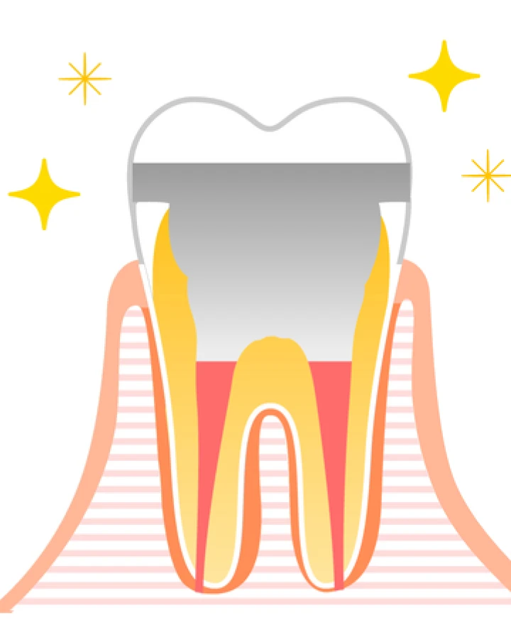 型取りを行い、専用の被せ物を取り付けます。