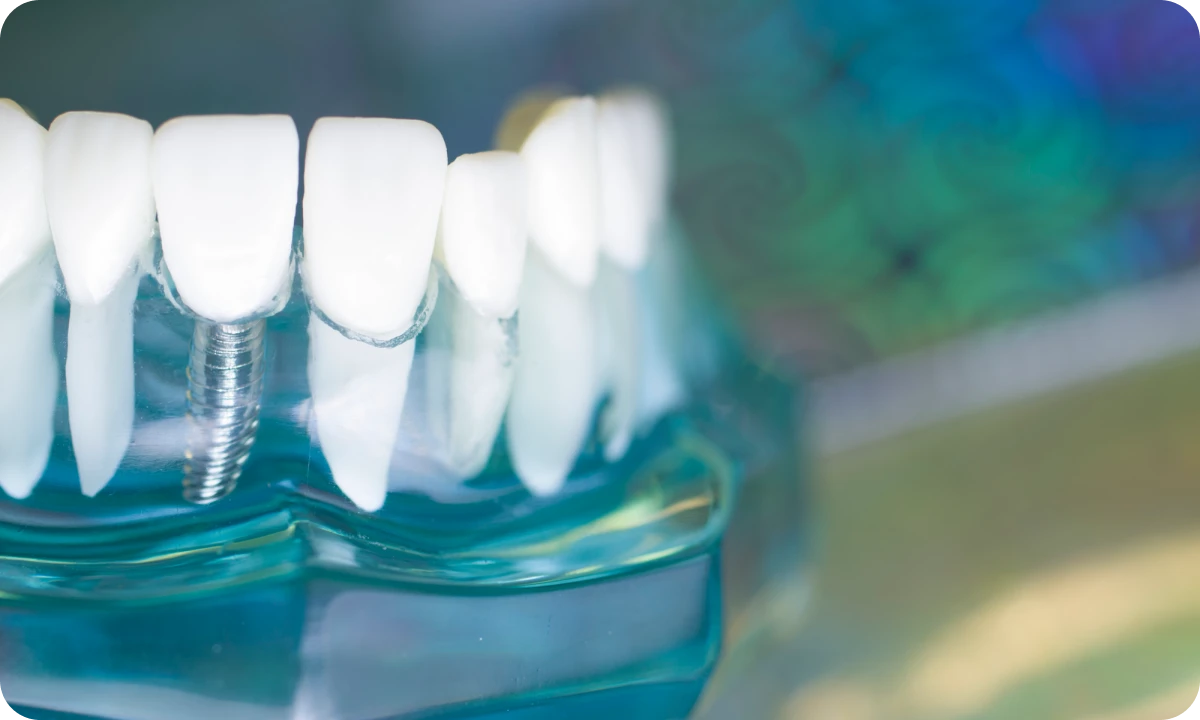 インプラントのメリット・デメリット