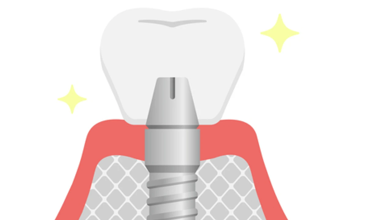 STEP05 人工の歯を装着