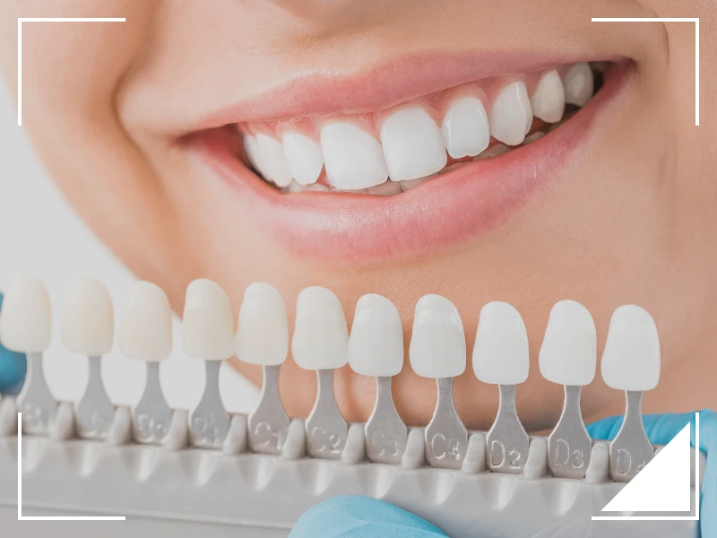 ホワイトニング