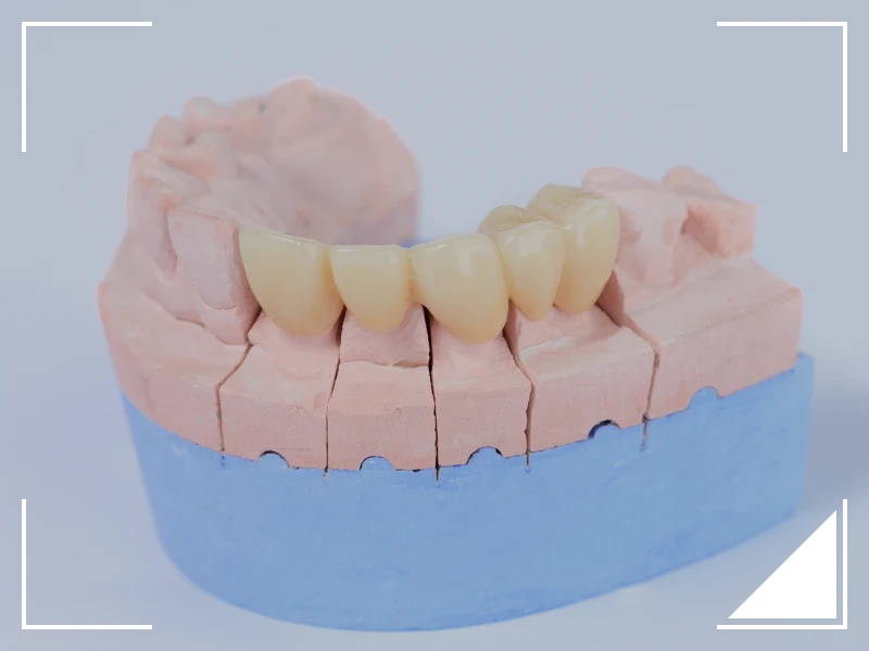 セラミック治療