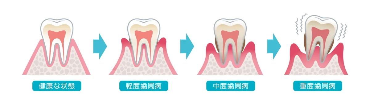 歯周病検査について
