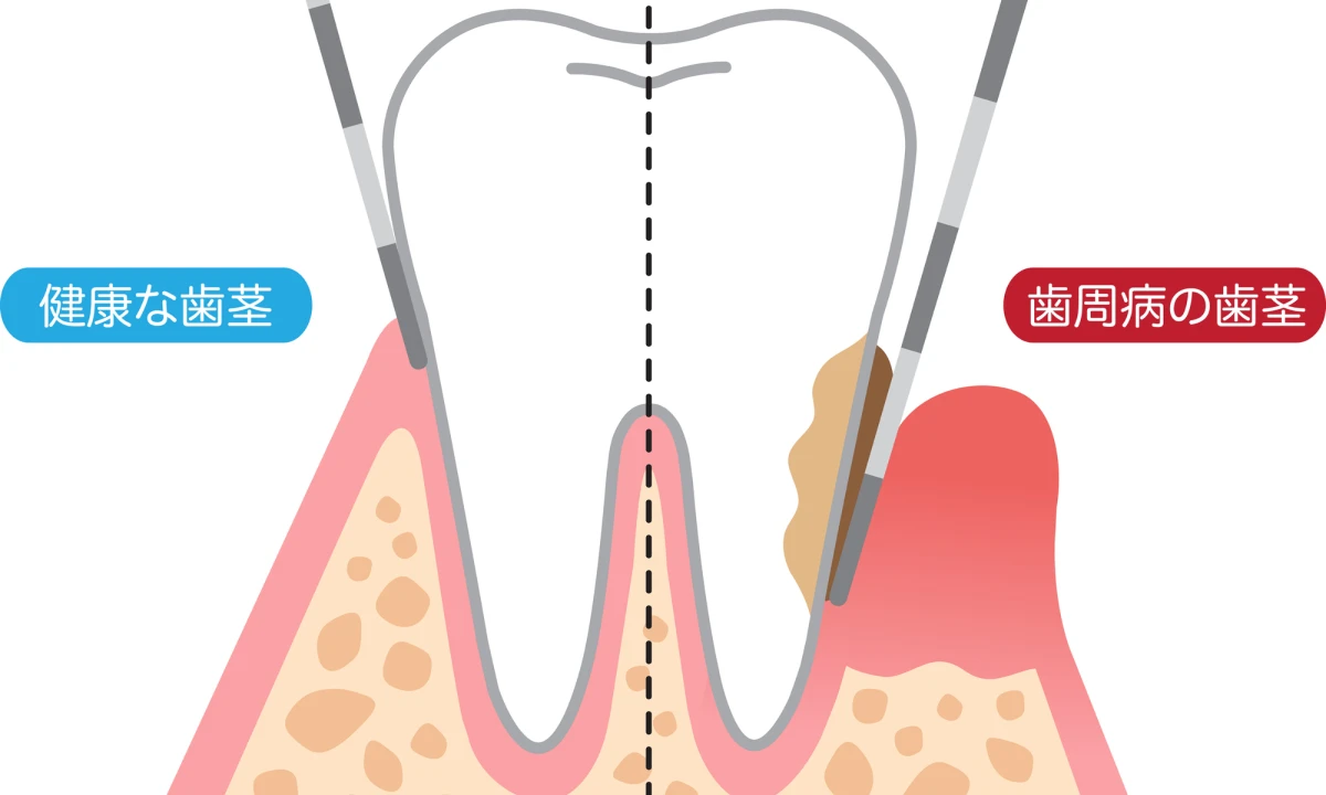 歯周ポケット検査（プロービング検査）