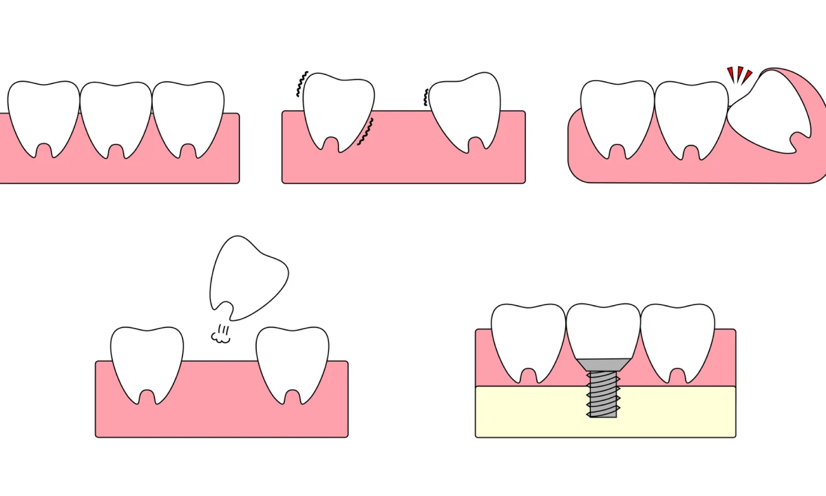 出血の有無（出血指数）